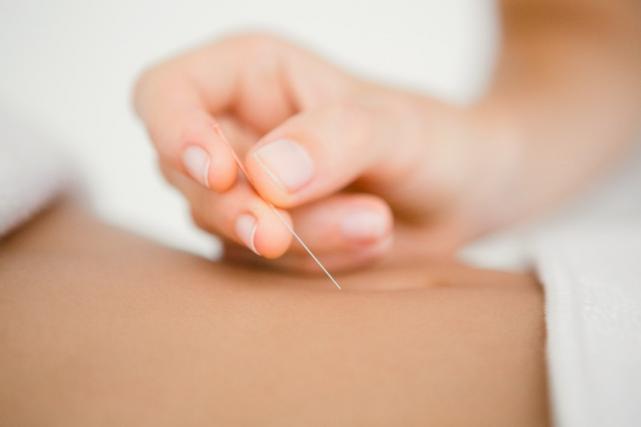 Séance de dry needling